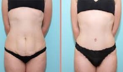 abdominoplastie tunisie avant apres