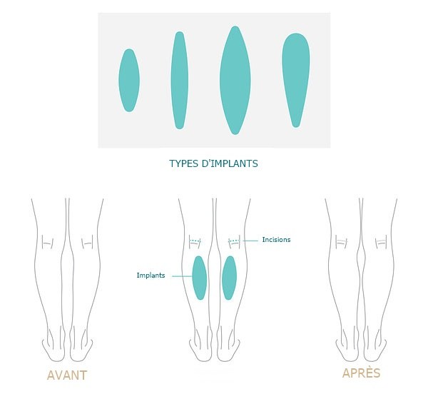 chirurgie esthetique mollets