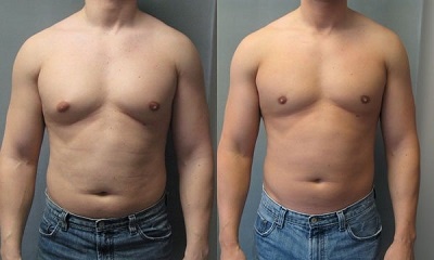 gynecomastie tunisie avant apres