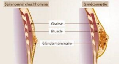 gynecomastie tunisie