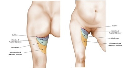 lifting cuisses en tunisie