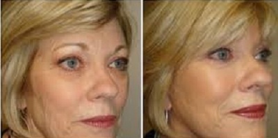 lipofilling facial tunisie