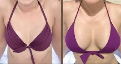 lipofilling seins tunisie avant apres