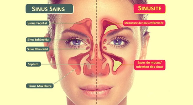 sinusite