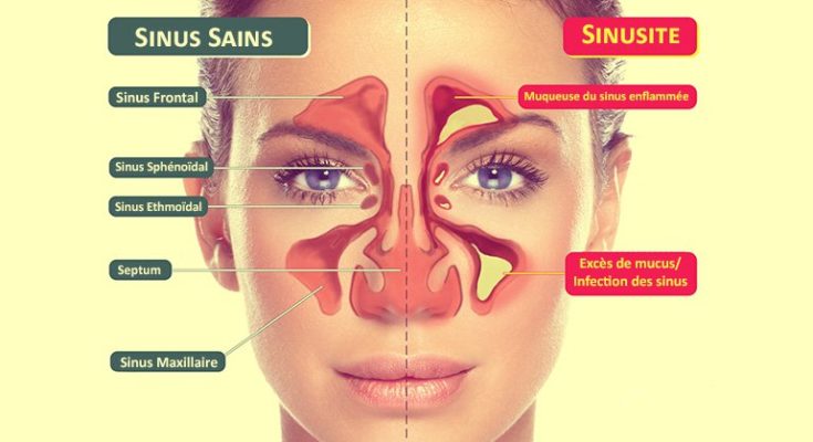 Sinus : définition et schéma (frontal, maxillaire)