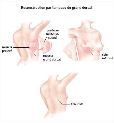 reconstruction-mammaire