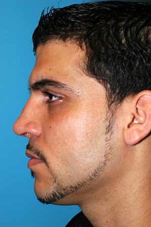 rhinoplastie apres