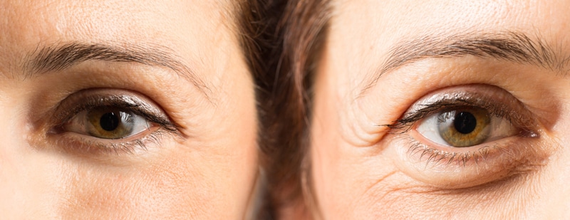 blepharoplastie laser avant apres