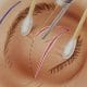 blepharoplastie laser co2