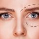 blepharoplastie