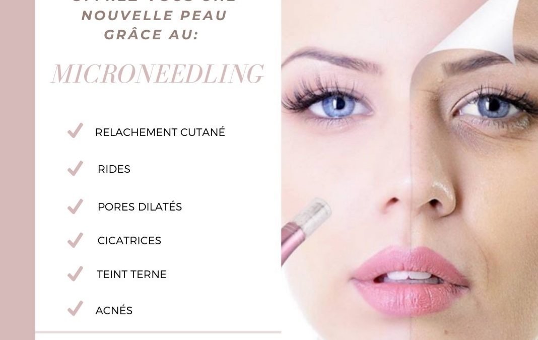 microneedling