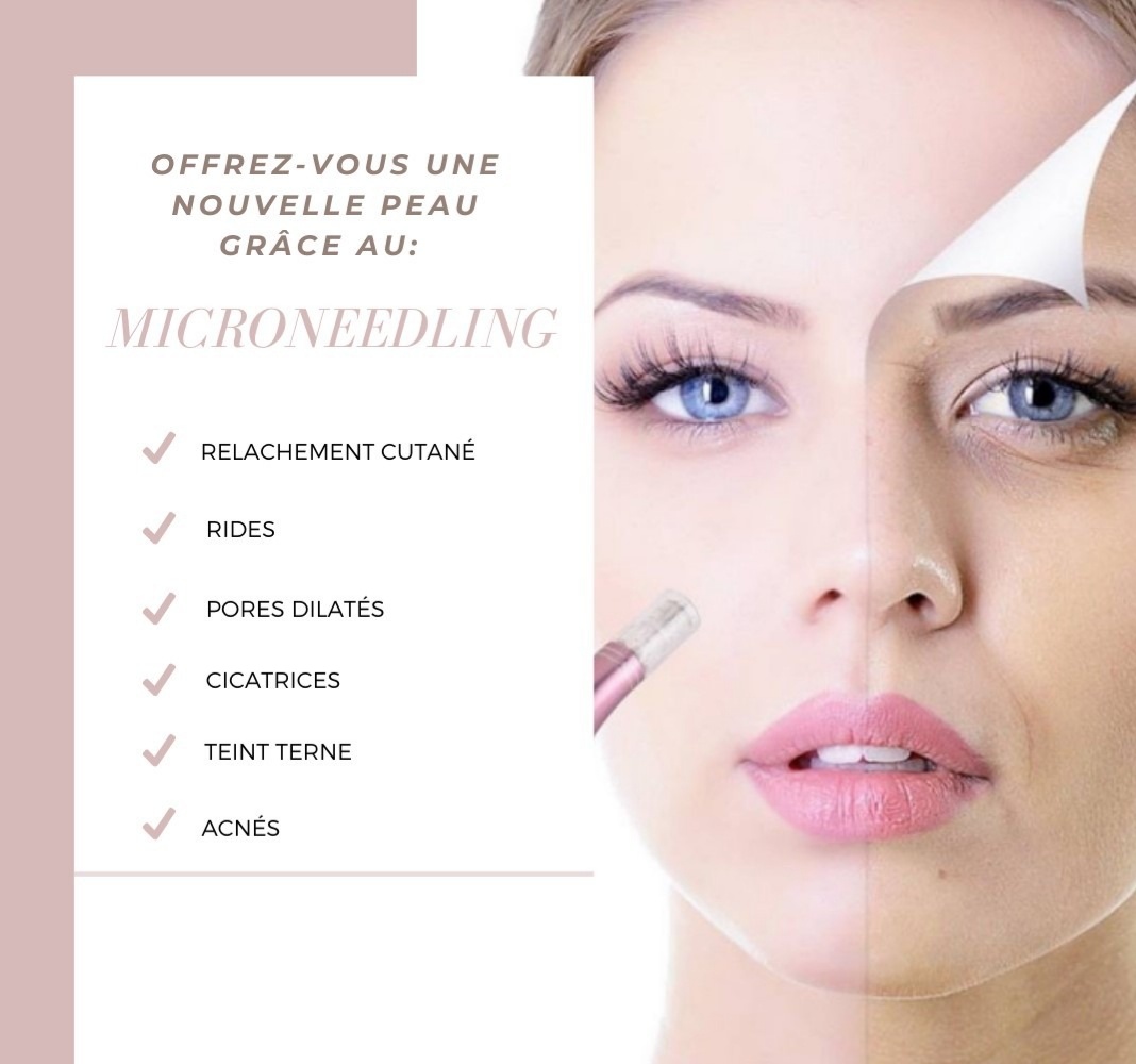 microneedling