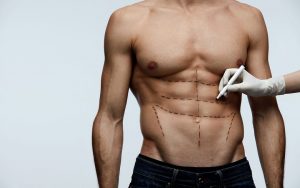 abdominal etching