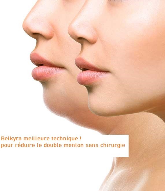 Belkyra pour double menton