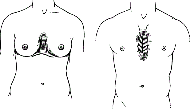 pectus excavatum femme