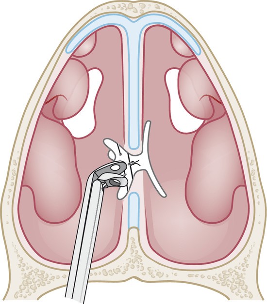 perforation septale