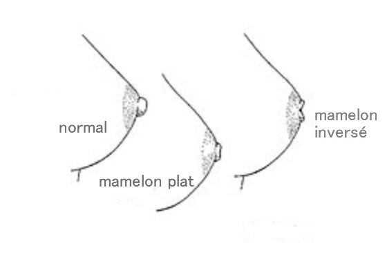 mamelon ombilique