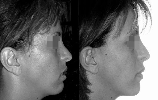 rhinoplastie secondaire