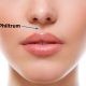 chirurgie reduction philtrum