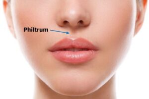 chirurgie reduction philtrum