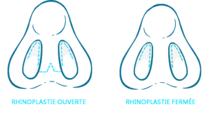 rhinoplastie ouverte ou fermée