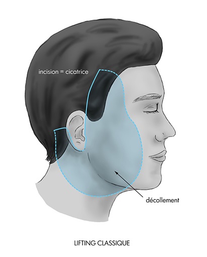 cicatrice lifting cervico facial