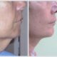 suivi resultat lifting cervico facial