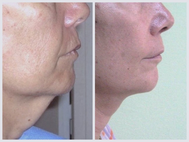 suivi resultat lifting cervico facial