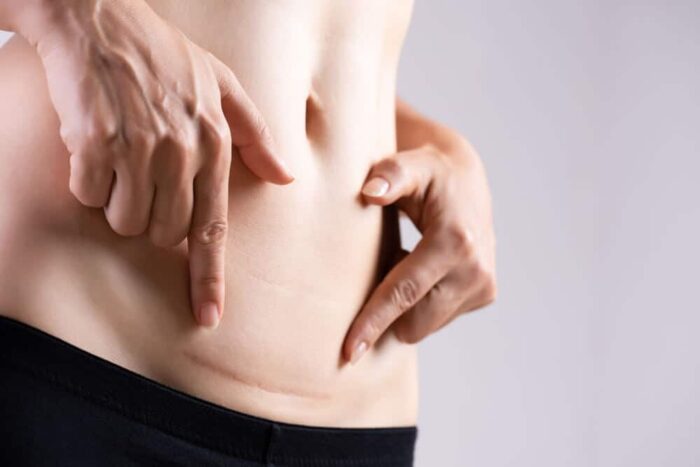 comment masser cicatrices apres abdominoplastie