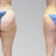 micro liposuccion trisculpt