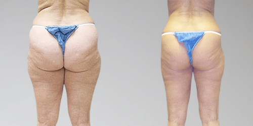 micro liposuccion trisculpt