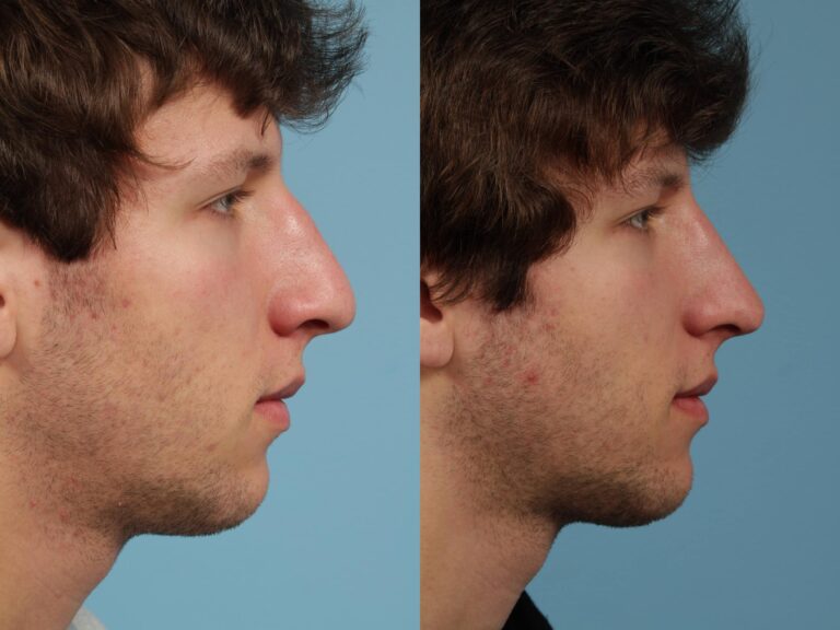 rhinoplastie homme avant apres