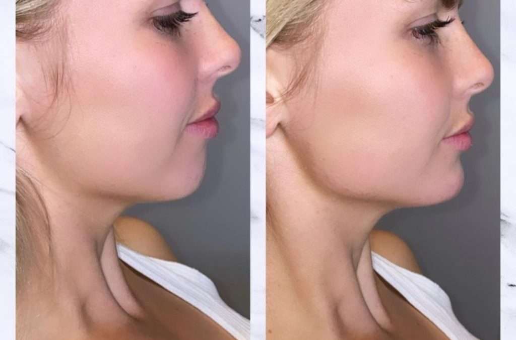 jawline contouring fillers