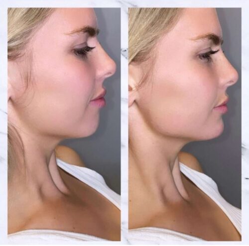 Jawline Contouring : redessiner sa mâchoire grâce à l'acide