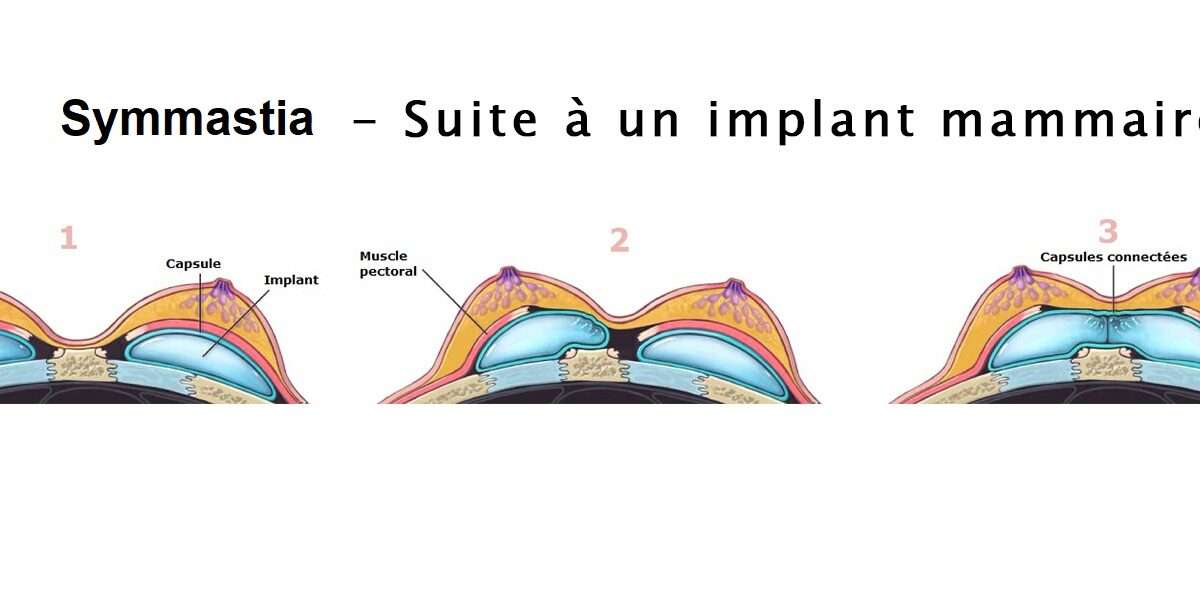 symmastia apres implant mammaire