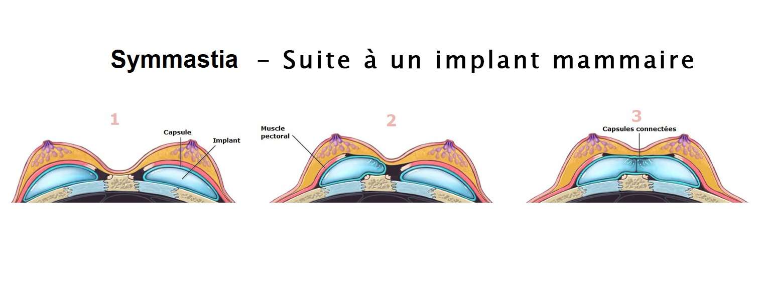 symmastia apres implant mammaire