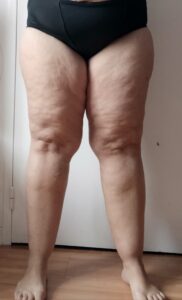 jambes poteaux traitement