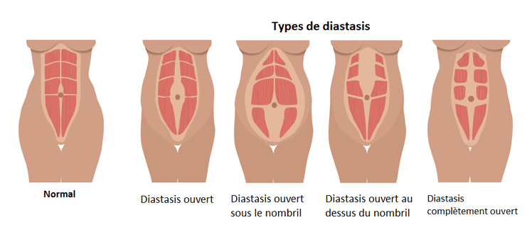 chirurgie diastasis