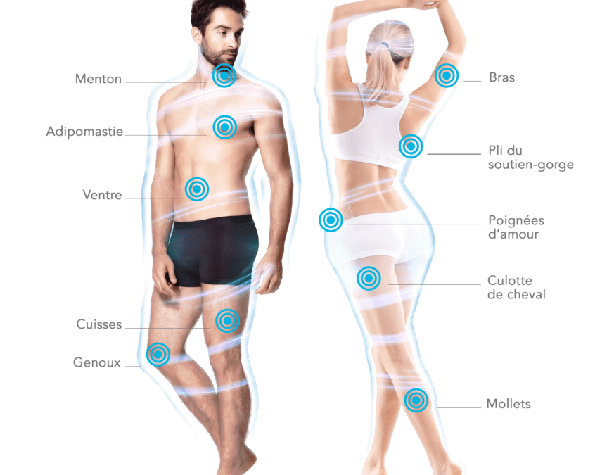 guide postoperatoire cryolipolyse