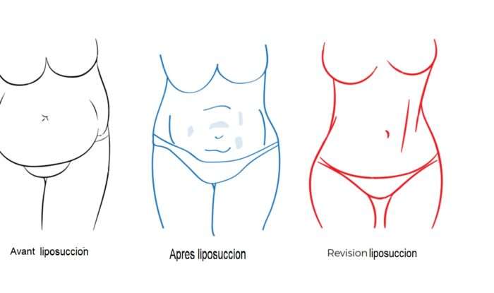 liposuccion de revision