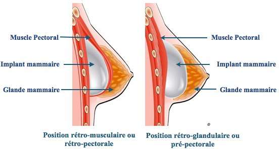 Augmentation mammaire position retro-glandulaire