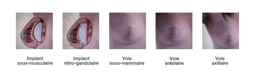 Augmentation mammaire par voie axillaire