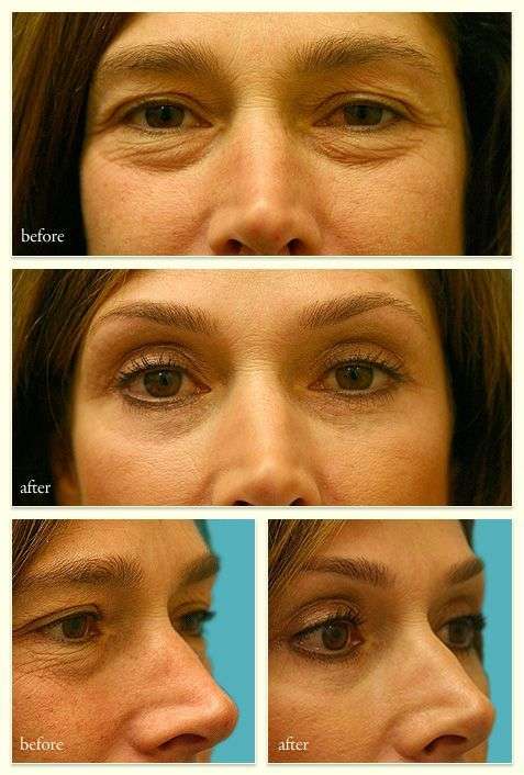 blepharoplastie et lifting temporal combinés avant apres