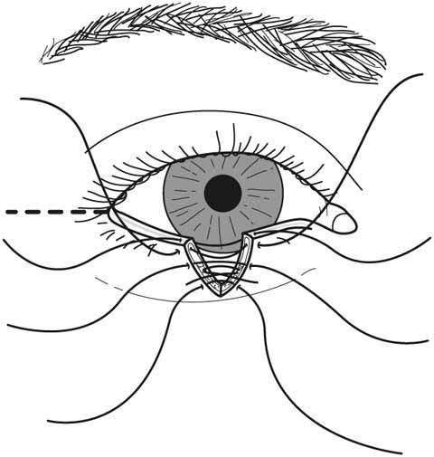 reconstruction des paupières