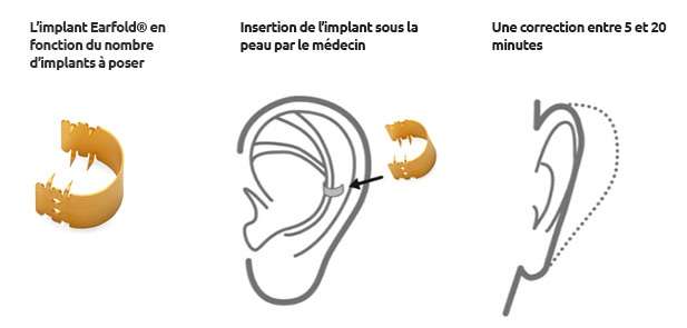 earfold
