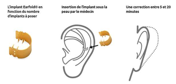 Implant Earfold, otospongiose - Diagnostic Dr Abidi