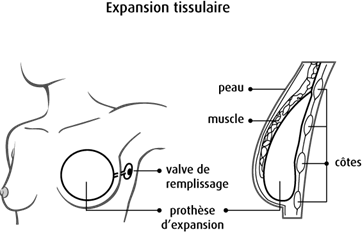 reconstruction mammaire par expandeur