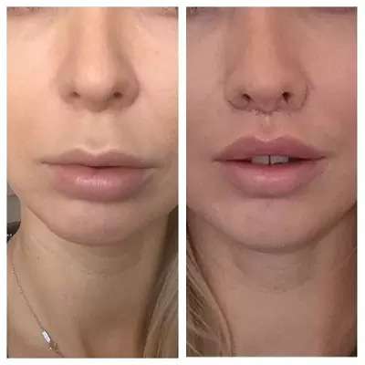 bullhorn lip lift