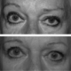 asymetrie yeux apres blepharoplastie