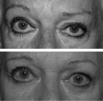 asymetrie yeux apres blepharoplastie